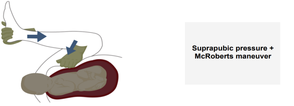 Suprapubic pressure applied with McRoberts maneuver during shoulder dystocia