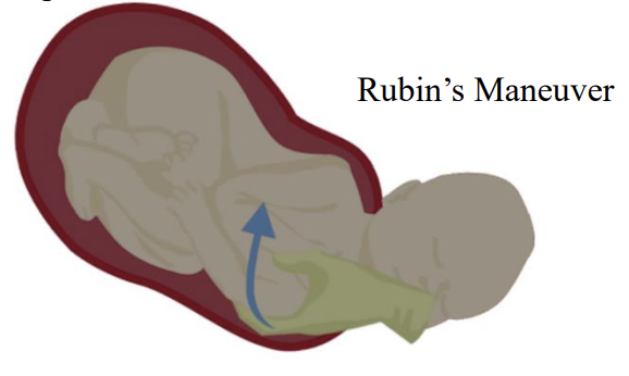 Rubin maneuver rotating the posterior fetal shoulder to relieve shoulder dystocia