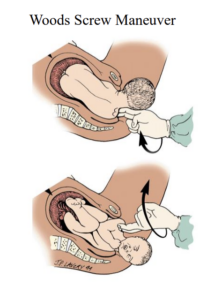 Woods screw maneuver rotating fetal shoulders to resolve shoulder dystocia