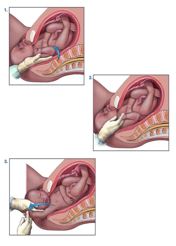 Posterior arm delivery technique reducing shoulder width during shoulder dystocia