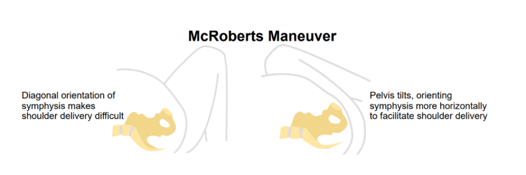McRoberts maneuver showing pelvic tilt to facilitate shoulder delivery
